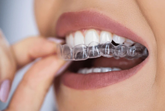 Clear Aligners in Rolling Meadows | 32 Dental 4U