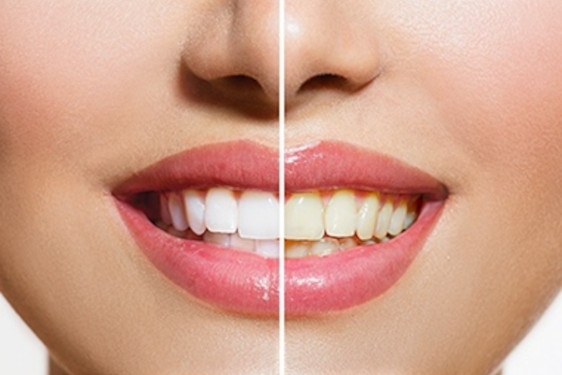 Teeth Whitening at 32 Dental 4U Rolling Meadows