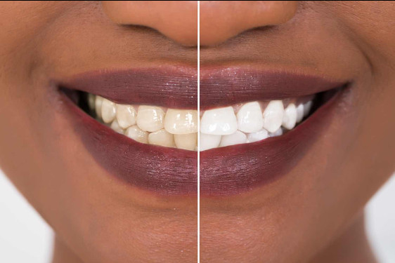 Teeth Whitening Rolling Meadows at 32 Dental 4U